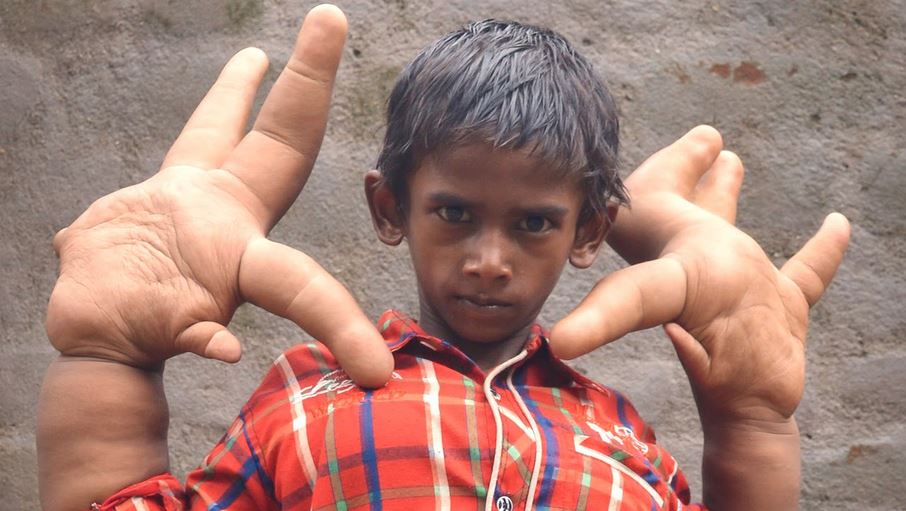 Mystery Condition Gives Indian Boy Gigantic Hands Reckon Talk   Kaleem Gigantic Hands 