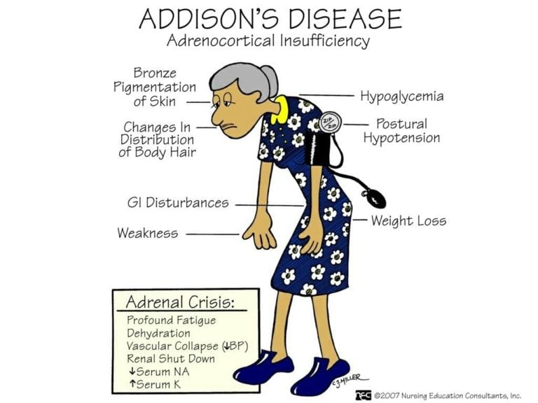 addisons disease skin